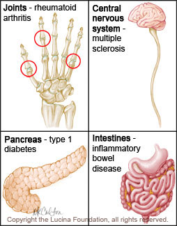 autoimmune-disease-lowres.jpg